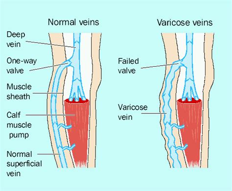 Leg Ulcers - Venous. Causes, symptoms, treatment Leg Ulcers - Venous