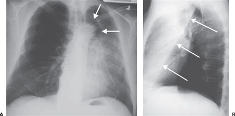 Signs And Patterns Of Lung Disease Radiology Key
