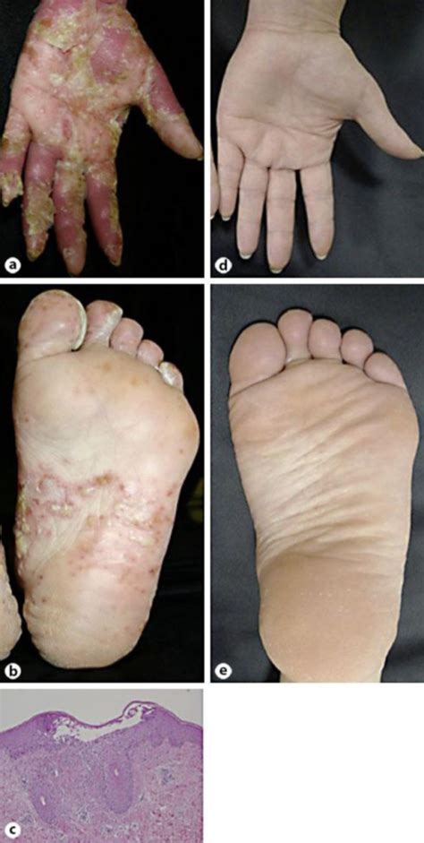 Clinical Appearances Of The Patients Pustular Psoriati Open I