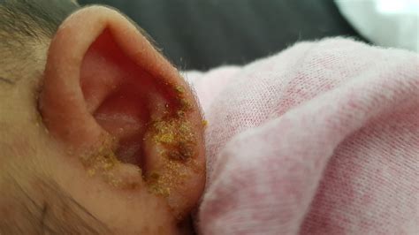 Yellow Crusty Earlobe February 2018 Babies Forums What To Expect