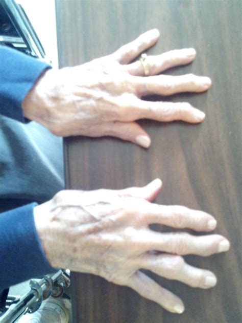 17 Best Images About Arthritis On Pinterest Rheumatoid