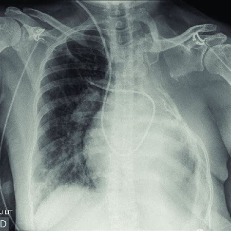 Chest X Ray Demonstrating The Normal Position Of The Pac Tip In The