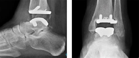 Current And Emerging Insights On Total Ankle Replacement