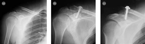 Figure 3 From Treatment Of Neer Type 2 Fractures Of The Distal Clavicle