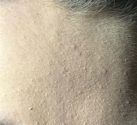 Acne Any Advice To Help With These Awful Bumps Rskincareaddiction