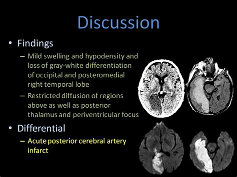 A cerebral stroke is an acute neurologic injury involving the cerebral hemispheres. HeadNeckBrainSpine
