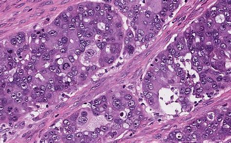 High Grade Serous Carcinoma Of The Ovary And Fallopian Tube