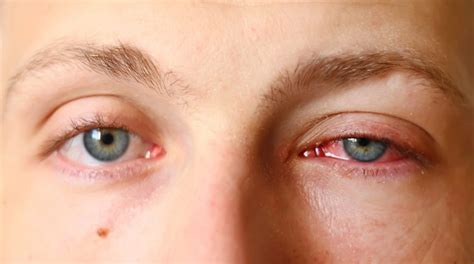 Pink Eye Conjunctivitis Symptoms And Treatment Page 8 Things Health