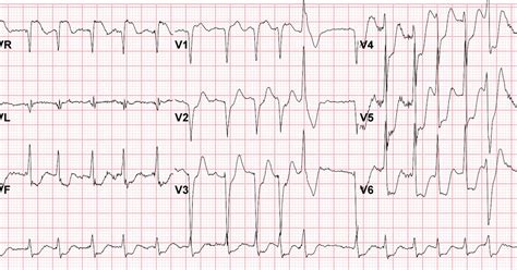 Dr Smiths Ecg Blog St Elevation In Avr With Diffuse St Depression