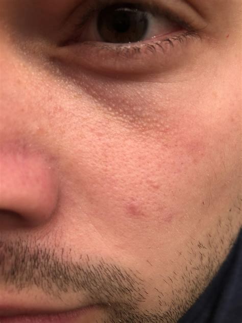 Skin Concerns Any Advice On How To Deal With The Bumps Underneath My