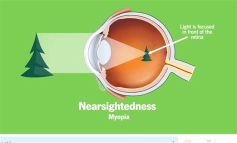 Eye Health The Causes Of Nearsightedness Myopia Boomers Daily
