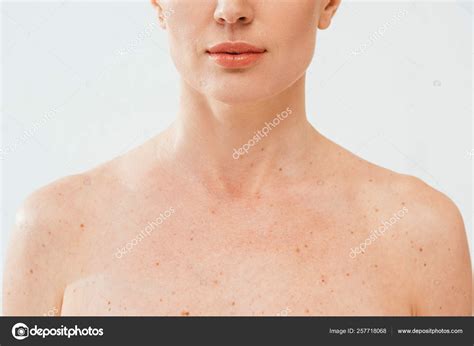 Cropped View Nude Woman Melanoma Isolated White Stock Photo