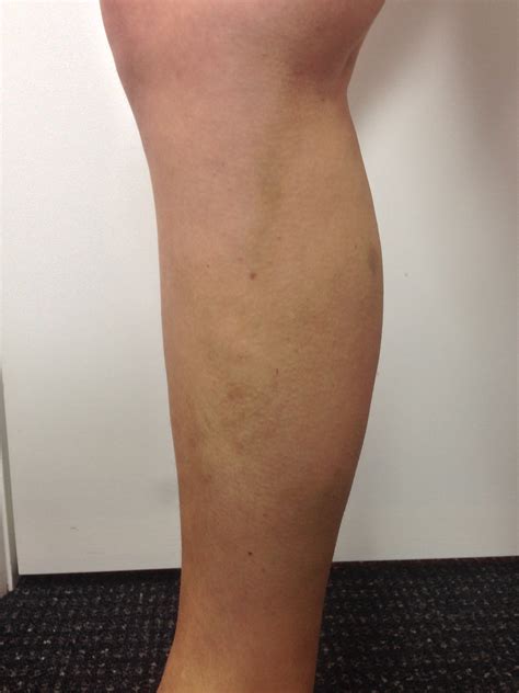 Varicose Vein Results And Post Treatment Photos — The Leg Vein Doctor