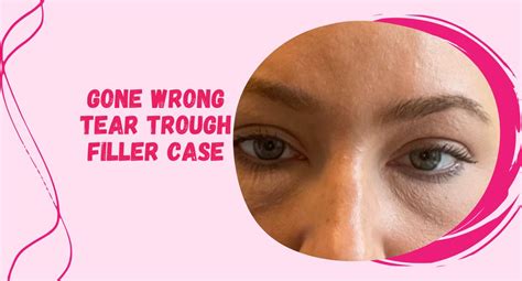 Everything You Need To Know About Tear Trough Filler