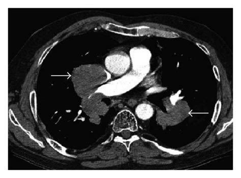 Axial Ct Thorax Postintravenous Contrast At The Level Of T6 Diffuse