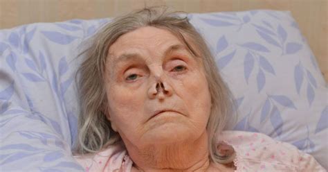 Elderly Woman Left With Hole In Face After Docs Fail To Spot Cancer