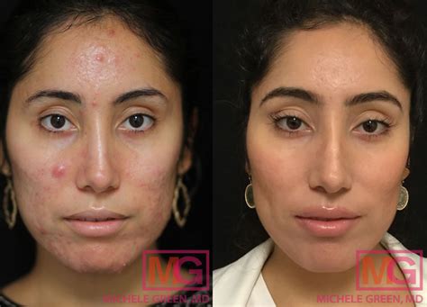 Accutane For Acne Treatment Dr Michele Green Md