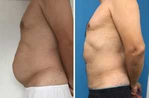 Liposuction in the chest area is more commonly performed on men than women. Liposuction Cost UK vs Turkey - Up to 75% OFF Lipo | MedAway