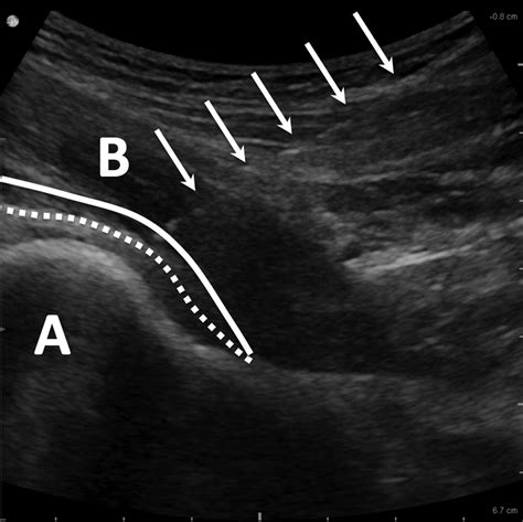 Iliopsoas Clinics In Sports Medicine