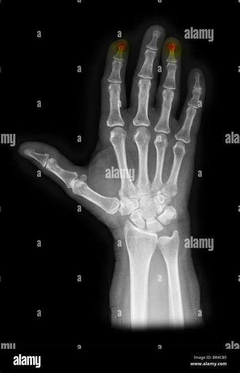 Hand X Ray Showing Crushed Fingertips Hand X Ray Showing Fractures