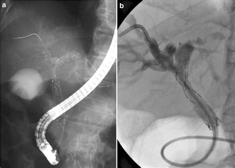 Side By Side Versus Stent In Stent Deployment In Bilateral Endoscopic