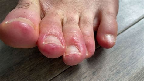 Covid Toes Could Skin Conditions Offer Coronavirus Clues Gma