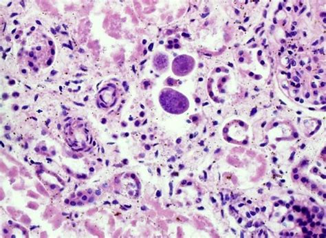 Qiaos Pathology Kidney Cytomegalovirus Cmv Infection Flickr