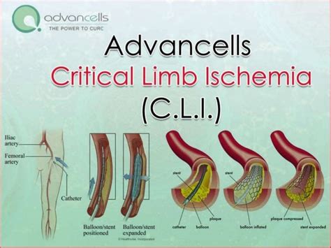 Critical Limb Ischemia Cli