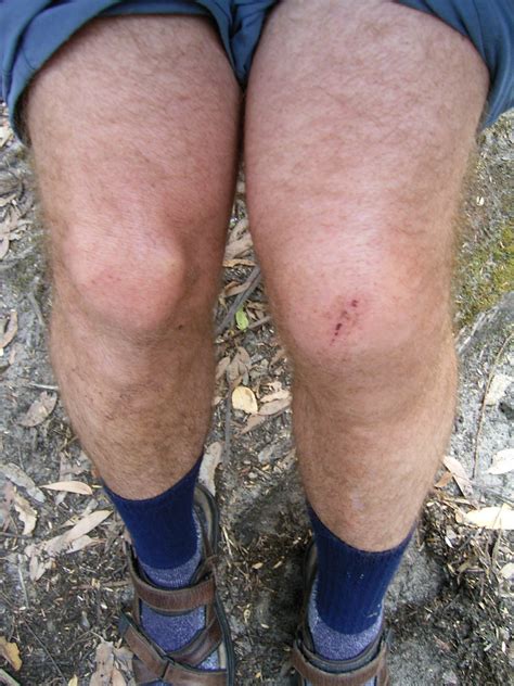 391 Broken Knee Cap Of Christo Christo Norman Flickr