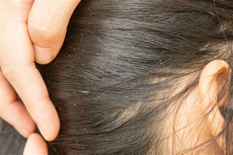 Head Lice Head Lice Symptoms