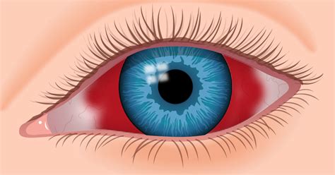 Hémorragie sous conjonctivale Tache de sang sur l œil