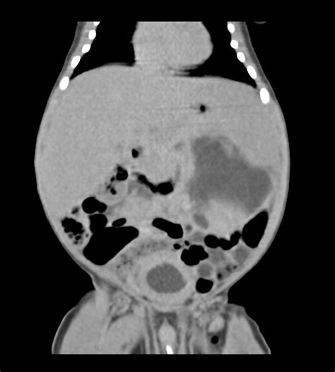 Urinoma Secondary To Posterior Urethral Valve Image Radiopaedia Org