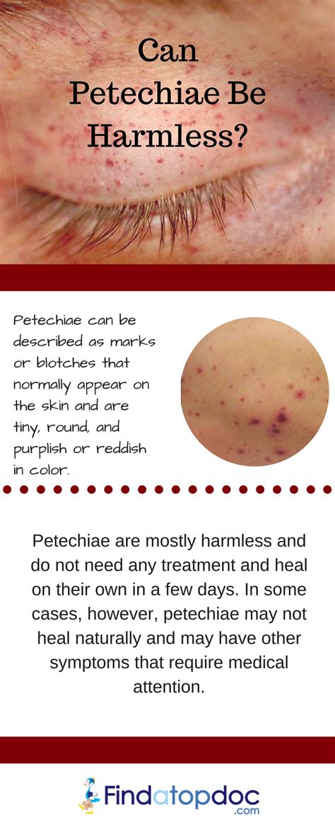 What Is Petechiae And What Are Its Causes