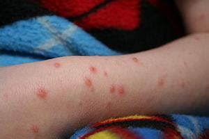 Mild Case Of Chickenpox In Toddler Weihnachtsdeko Selber Machen