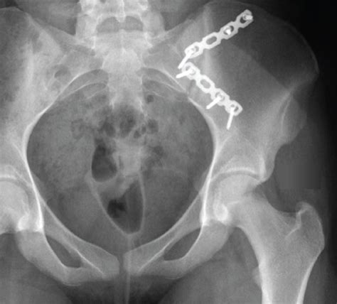 Postoperative Anteroposterior Pelvic Radiograph Showing The Si Joint