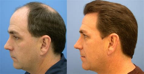 This Is What You Need To Know About Fue Hair Transplant Lifehack