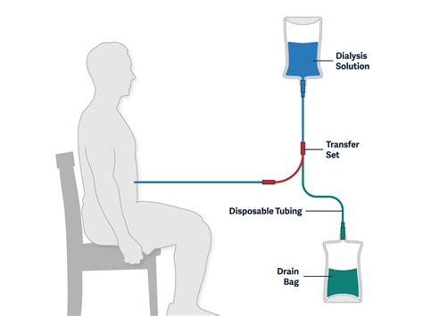 Kidney Care Options Peritoneal Dialysis Us Renal Care