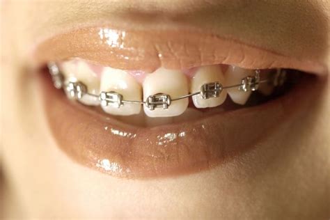 Metal Braces In The Mouth Стоматология и Губы