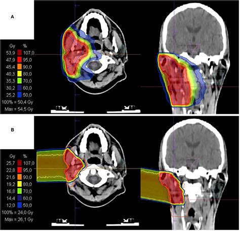 Frontiers Intensity Modulated Radiotherapy Imrt With Carbon Ion