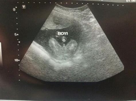 Check spelling or type a new query. Gender Reveal Ultrasound *pics* - BabyCenter