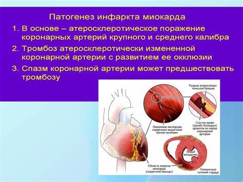 Инфаркт миокарда обширный диета Инфаркт Миокарда - online presentation Инфаркт Миокарда - online presentation Инфаркт миокарда обширный диета