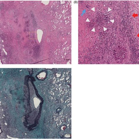 Concomitant Aspergillus Infection Observed In Granulomatous Lesion In Download Scientific