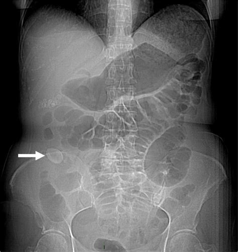 Plain Abdominal X Ray Showing An Obstruction And Dilated Intestinal