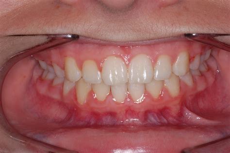 Truman Orthodontics Overbite Correction Using A Functional Appliance