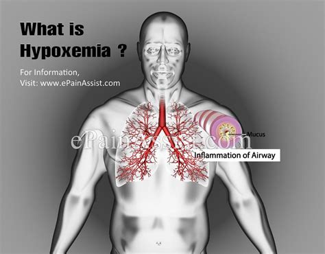 What Is Hypoxemia And How Does It Differ From Hypoxiatypes Causes