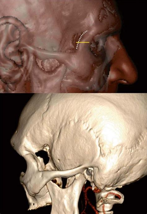 Endoscopic Lateral Orbitotomy Neurosurgery Blog