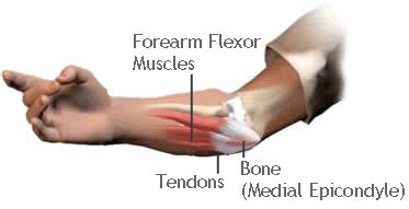 Elbow/forearm tendon ligament tear | health life media. Corp Med - Tendonitis is inflammation of the tendons ...