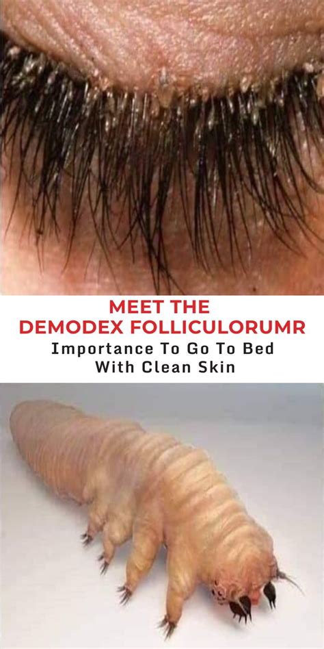 Meet The Demodex Folliculorum Importance Of Removing Your Make Up