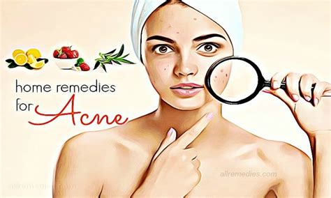 39 Natural Home Remedies For Acne On Face And Body