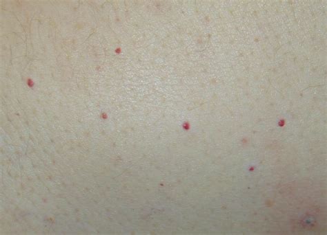 How To Treat Dots Bumps And Red Spots On Skin Skin Spots Dots Red Dots